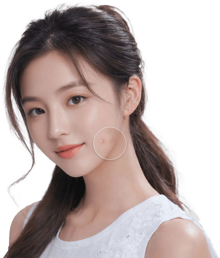 부천 여드름 흉터 홍반 치료, 붉은 기와 패인 자국은 다릅니다