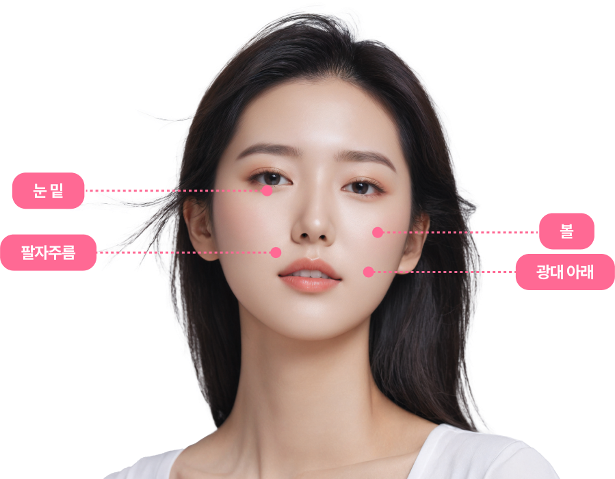 볼뉴머 적용 부위로 눈밑·볼·팔자주름·광대 아래를 표시한 그림